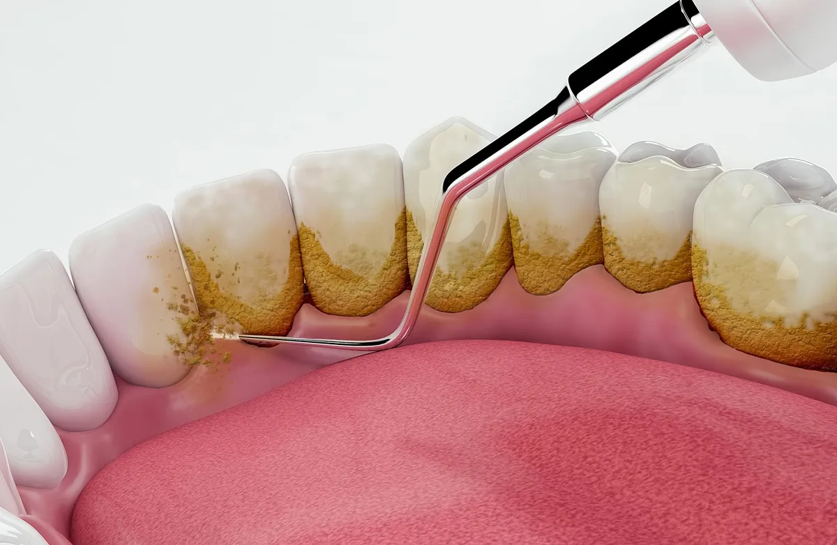 Illustration of a dental scaler removing hardened tartar from along the gum line of the lower teeth