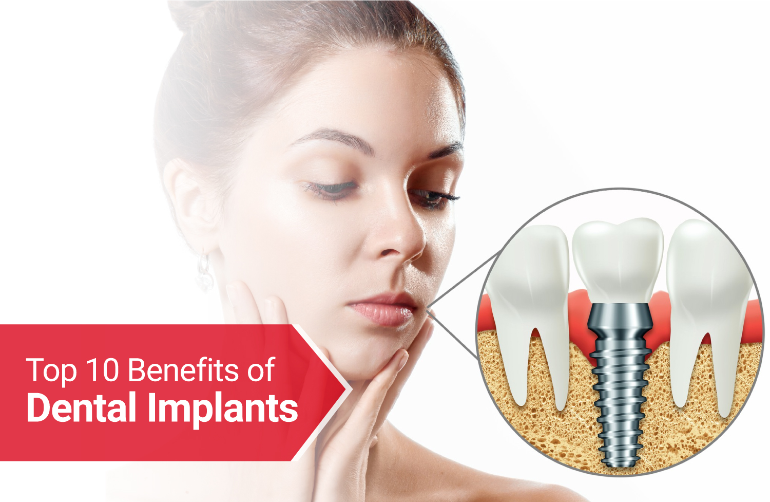 dental implants