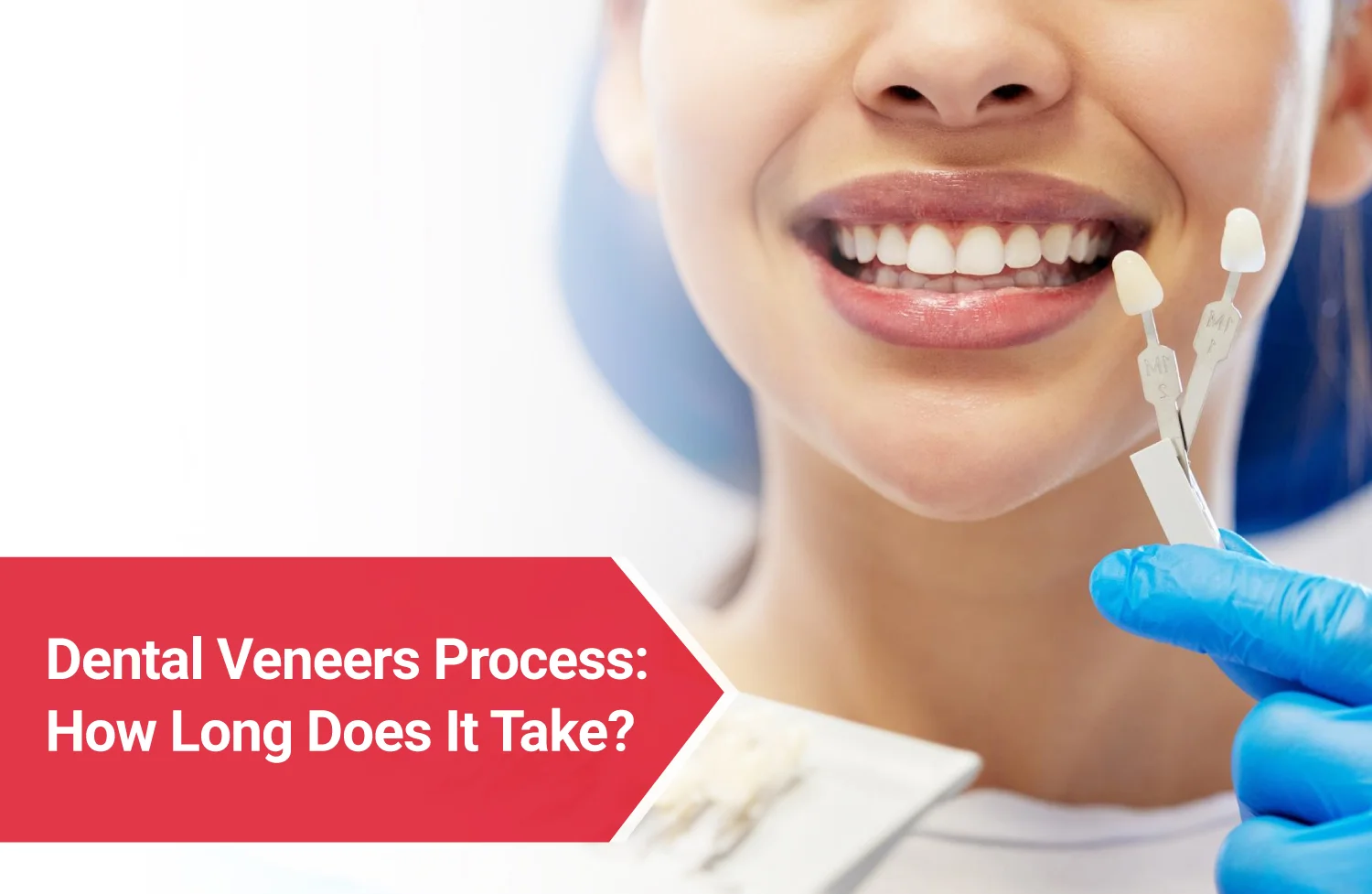 dental veneers process