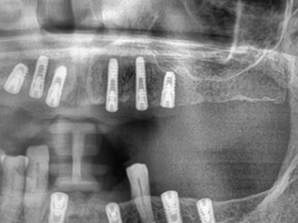Panoramic X-ray of the upper and lower jaws with multiple dental implants replacing missing teeth across both arches